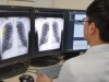 서울대병원, 국내 최초로 폐질환 영상 판독에 인공지능 활용
